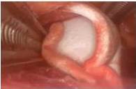 Colocaci&oacute;n de Gelfoam&reg;.