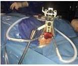 Colocaci&oacute;n a nivel axilar 