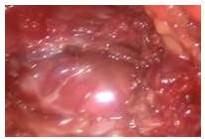 
Visualizaci&oacute;n de gl&aacute;ndula tiroides. N&oacute;tese haz esternal superiormente del
m&uacute;sculo esternocleidomastoideo