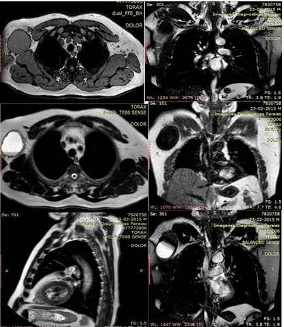 Resonancia
magn&eacute;tica. Imagen axial, coronal, sagital con y sin contraste. T&eacute;cnica predominio de T1, T2 revelan la presencia de lesi&oacute;n
ocupante de espacio ovalada de 7,3 cm x 6,2 cm x 10 cm en regi&oacute;n axilar medial
derecha, discretamente hiperintensa al m&uacute;sculo en T1, doble se&ntilde;al en secuencia
T2 y supresi&oacute;n de grasa en relaci&oacute;n a alto contenido proteico-material
purulenta Presencia de pared gruesa con deformidad de la superficie cut&aacute;nea sin
embargo, no hay edema significativo de los tejidos blandos peri-lesionales.