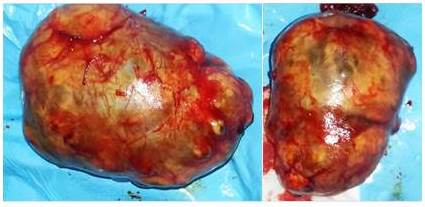Pieza macrosc&oacute;pica. Lesi&oacute;n tumoral que mide 11 cm x 6,5
cm x 5,1 cm, aparentemente encapsulada, superficie externa lisa, suave con
tractos vasculares visibles al corte se aprecia salida de l&iacute;quido de aspecto
hemorr&aacute;gico, con tejido lobulado, amarillento, untuoso con a&eacute;reas marr&oacute;n
gris&aacute;ceas resplandeciente con un color tostado claro.