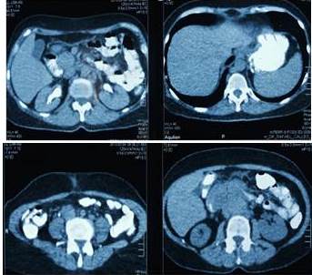TAC Abdominop&eacute;lvica con contraste oral y endovenosa en fase de eliminaci&oacute;n,
cortes axiales.