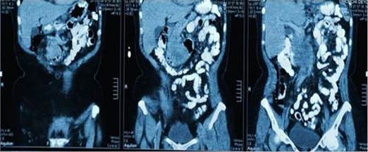 TAC abdominop&eacute;lvica con
contraste oral y endovenosa en fase de eliminaci&oacute;n, cortes coronales.
