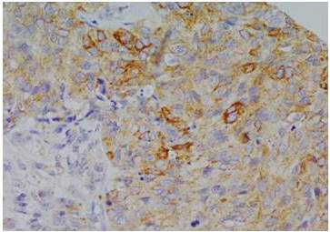 Inmunohistoquímica. Células CD44+ en TNBC con
marcación en citoplasma y membrana celular. (Creative Commons Attribution License) (69). 

 