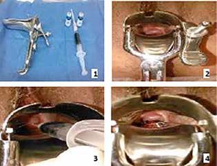 Materiales a utilizar. 2. Visualización del cuello
uterino. 3 y 4. Infiltración del colorante y retiro de material.