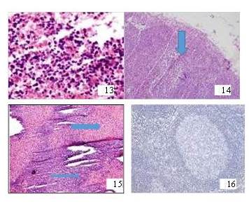 3. Impronta de GC negativo
para neoplasia. H&E: 10x. 14. GC
iliaco externo: negativo para neoplasia. H&E: 10x. 15. Corte histológico por congelación:
hiperplasia sinusoidal (flechas). H&E: 4x. 16. Inmunohistoquímica con
CKAE1/AE3 negativa para metástasis