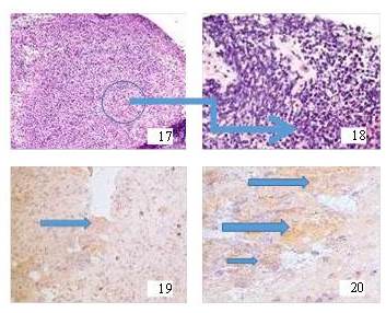 7 y 18. GC negativo para neoplasia. H&E: 4x y 20x. 19 y 20. Inmunohistoquímica
positiva CKAE1/AE3.