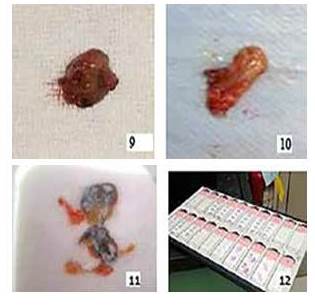 9 y 10. GC posterior a exéresis. 11. Bloque de corte congelado
del GC teñido con azul patente. 12. Cortes seriados de improntas citológicas y
biopsias de ganglios linfático.