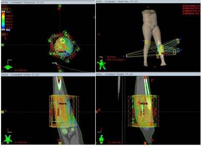 Paciente masculino de 11 a&ntilde;os con SE extra&oacute;seo en
regi&oacute;n tibial izquierda enfermedad localizada. Se realiz&oacute; biopsia incisional. QT:
vincristina, doxorrubicina y ciclofosfamida con ifosfamida, etop&oacute;sido. Luego
RTIM a la semana 12, dosis 5 580 cGy, paciente actualmente VSE a los 52 meses. Plan de tratamiento en
proyecciones axial, coronal y sagital,
donde se aprecia la distribuci&oacute;n porcentual de la dosis representada por
diversas tonalidades de colores, cuyos valores pueden observarse en la columna
de la izquierda. Posterior continu&oacute; con QT hasta cumplir 48 semanas.