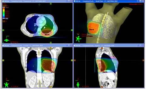 Paciente femenina de 11 a&ntilde;os de edad con tumor de
Askin en 8o arco costal izquierdo. Se realiz&oacute; resecci&oacute;n de 8o
arco costal y resecci&oacute;n de l&oacute;bulo inferior de pulm&oacute;n izquierdo. Recibi&oacute;
quimioterapia con vincristina, doxorrubicina, ciclofosfamida alterno con
ifosfamida, etop&oacute;sido, luego en la semana 12 recibi&oacute; RTC3D dosis 5 040 cGy y posteriormente QT hasta
cumplir 48 semanas de tratamiento. Paciente actualmente VSE a los 38 meses. Plan de tratamiento en
proyecciones axial, coronal y sagital,
donde se aprecia la distribuci&oacute;n porcentual de la dosis representada por
diversas tonalidades de colores, cuyos valores pueden observarse en la columna
de la izquierda.