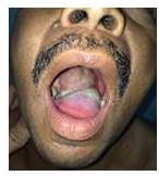 Tumor en borde derecho de lengua