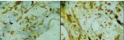 IHQ (2015-00012). De
izquierda a derecha: inmunorreacci&oacute;n positiva a vimentina y prote&iacute;na S100,
respectivamente. 

 