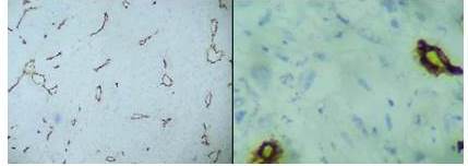 IHQ (2015-00012). De izquierda a derecha: Inmunorreacci&oacute;n negativa a CD
31 y CD 34, respectivamente