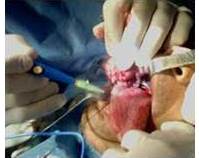 Resecci&oacute;n quir&uacute;rgica transoral de tumor en borde derecho de lengua 

 