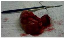 Esp&eacute;cimen quir&uacute;rgico