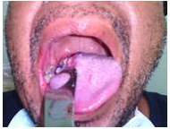 Evoluci&oacute;n al 10&deg; d&iacute;a de posoperatorio