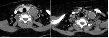 TAC LOE
supraclavicular izquierdo