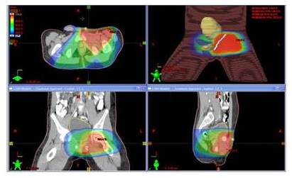 Paciente masculino de 12 a&ntilde;os con RMS embrionario
paratesticular izquierdo Grupo II, estadio IB. Se practica orquidectom&iacute;a
radical izquierda por v&iacute;a inguinal, bordes de resecci&oacute;n positivos. Recibe QT
con VAC 3 ciclos, luego RTC3D a hemiescroto y regi&oacute;n inguinal izquierdo, dosis
4 140 cGy, Plan de tratamiento en proyecciones axial, coronal y sagital, donde se aprecia la distribuci&oacute;n
porcentual de la dosis representada por diversas tonalidades de colores, cuyos
valores pueden observarse en la columna de la izquierda. QT posterior hasta
completar 37 semanas. Recidiva a nivel para&oacute;rtico a los 29 meses post
tratamiento. Recibe QT con ifosfamida, carboplatino y etop&oacute;sido sin respuesta
adecuada. Se realiza resecci&oacute;n con bordes positivos, se administra RT 4 500 cGy
a regi&oacute;n para&oacute;rtica, y posterior QT, paciente fallece por enfermedad
retroperitoneal pero con control local a los 47 meses.