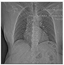 Radiografías póstero-anterior de tórax, se observa imagen para-cardiaca izquierda a nivel
del parénquima pulmonar tipo nodular, densa ovalada de borde bien definidos y
sin calcificaciones u otras anomalías.
