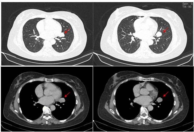  Tomografía computada
de alta
resolución se muestran unos cortes axiales lesión nodular ovalada, homogénea de 26 mm, adyacente
al hilio pulmonar izquierdo, borde bien definidos. Resto del parénquima
pulmonar sin lesiones focales, estructuras adyacentes conservadas (flechas
rojas).