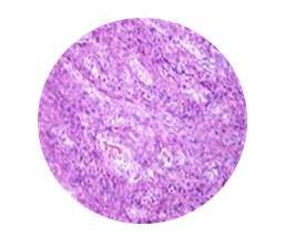 Microfotografía: lesión neoplásica maligna se aprecia la coexistencia de
ambos componentes celulares fusiforme y epitelioide sarcoma sinovial bifásico
primario de pulmón H/E x 40.