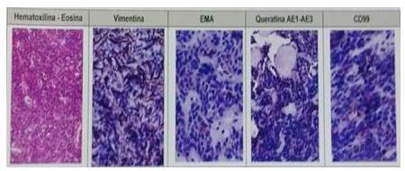 Microfotografía: inmunohistoquímica,
mediante la técnica de estreptavidina-biotina y utilizando el método de
recuperación antigénica: queratina AE1-AE3, antígeno e membrana epitelial
(EMA), vimentina, CD34, proteína S100, CD99 positivos en células neoplásicas.
Sarcoma sinovial bifásico primario de pulmón.