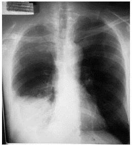 Radiografía
PA de tórax: imagen de opacidad en el campo pulmonar derecho a nivel de su
base, densa homogénea sin broncograma aéreo que borra la visualización del
contorno cardíaco asimismo los ángulos costo-frénicos y cardio-frénicos 

 