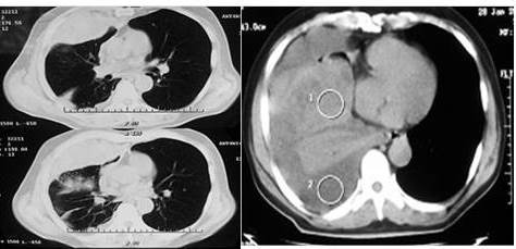 Tomografía computada: imagen de masa redondeada, homogénea de 33 mm x 13,7 mm,
que ocupa la base del pulmón derecho.