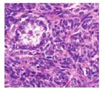 Microfotografía lesión neoplásica maligna se aprecia
la coexistencia de ambos componentes celulares fusiforme y epitelioide sarcoma
sinovial primario de pulmón H/E x 40.