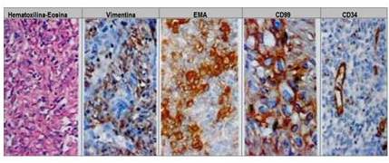 Microfotografía
lesión neoplásica maligna se aprecia la coexistencia de ambos componentes celulares
fusiforme y epitelioide sarcoma sinovial primario de pulmón H/E x 40. Microfotografía:
inmunohistoquímica; CD99 positivos en células neoplásicas. Sarcoma sinovial
primario de pulmón monofásico