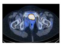 CT-PET LOE p&eacute;lvico