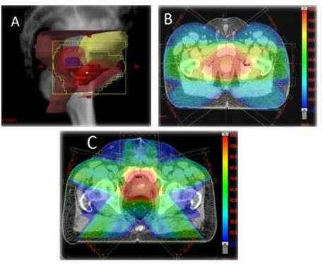Vista
del haz de tratamiento en RTC3D (A), distribución de dosis en plano axial en
RTC3D (B), distribución de dosis de plano axial para RTIM (C)