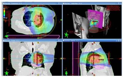 Distribución de dosis en plano axial, coronal y sagital
del plan de un tratamiento de un una lesión pulmonar. Para este caso se
utilizaron arcos axiales en conjunto con campos de RTC3D