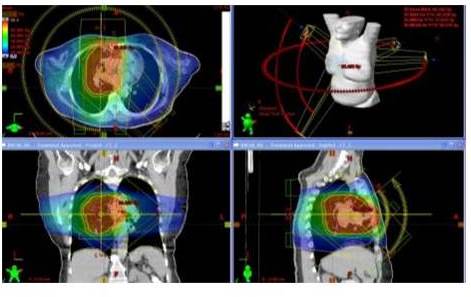 Distribución de dosis en plano axial, coronal y sagital del plan de un
tratamiento de un una lesión pulmonar. Para este caso se utilizaron arcos
axiales y sagitales de RAVM.