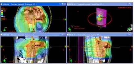 Distribución de dosis en plano axial, coronal y sagital del plan de un
tratamiento de un una lesión en estómago. Para este caso se utilizaron arcos
axiales de RAVM.