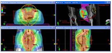 Distribución de dosis en plano axial, coronal y sagital del plan de un
tratamiento de un una lesión tumoral vaginal. Para este caso se utilizaron
arcos axiales de RAVM.