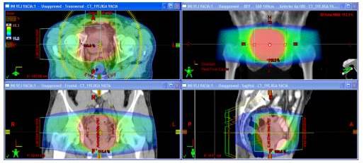Distribución de dosis en plano axial, coronal y sagital del plan de un
tratamiento de un una lesión tumoral vejiga. Para este caso se utilizaron arcos
axiales de RAVM.
