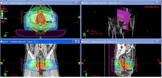 Distribución de dosis en plano axial, coronal y sagital del plan de un
tratamiento de un una lesión tumoral prostática. Para este caso se utilizaron
arcos axiales de RAVM.
