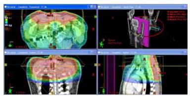 Distribución de dosis en plano
axial, coronal y sagital del plan de tratamiento de sarcoma de partes blandas. Para este caso se utilizaron arcos axiales de
RAVM.