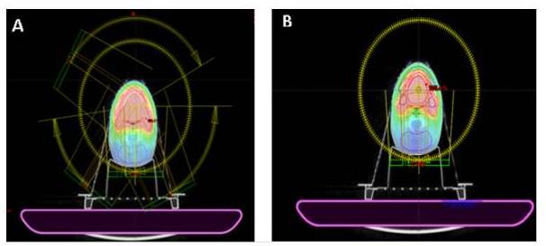 Distribución de dosis en plano axial de un plan de
tratamiento con TAIM (B)
y con RAVM (A).