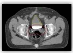 Corte tomográfico axial del plan de tratamiento. Se
observan las sub estructuras creadas (vejiga en amarillo y recto en blanco)
usadas únicamente para la optimización.