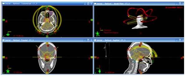 Distribución de dosis en plano axial, coronal y sagital del plan de un
tratamiento de macro-adenoma, hipofisario además de una vista tridimensional de
la disposición de los arcos.