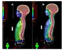 Distribución porcentual de la dosis en plano sagital del plan de
tratamiento de un méduloblastoma usando
RTC3D (A) y usando RAVM (B).