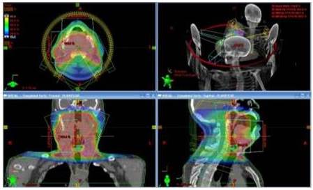 Distribución de dosis en plano
axial, coronal y sagital del plan de un tratamiento de un cáncer en orofaringe,
además de una vista tridimensional de la disposición de los arcos.