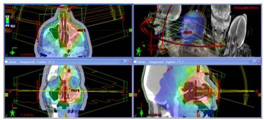 Distribución de dosis en plano
axial, coronal y sagital del plan de un tratamiento de un papiloma invertido.
Para este caso se utilizaron arcos sagitales de RAVM.
