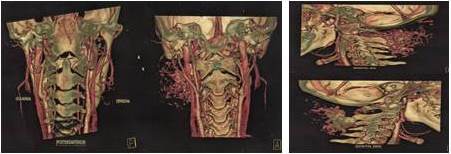 Corte posterior y sagital