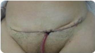 Incisi&oacute;n de Maryland.