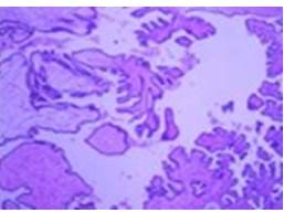 Tumor seroso borderline. Papilas que forman nidos de
c&eacute;lulas epiteliales que se separan del estroma. 

 
