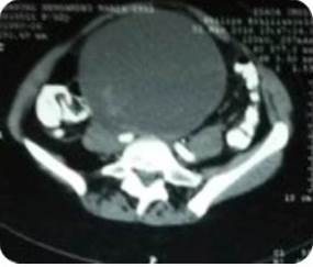 Tomograf&iacute;a Computarizada. Caso 3