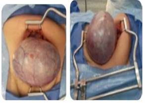 Caso 3 intra-operatorio